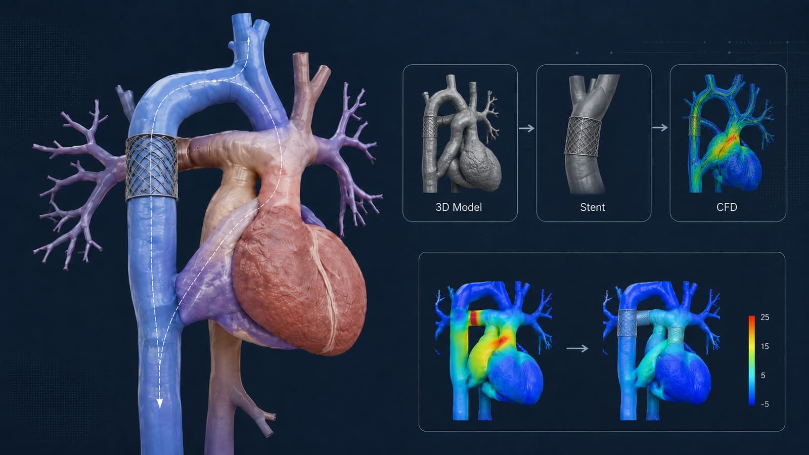 Pipeline from 3D patient model to virtual stent placement to CFD pressure simulation, with a before/after pressure comparison
