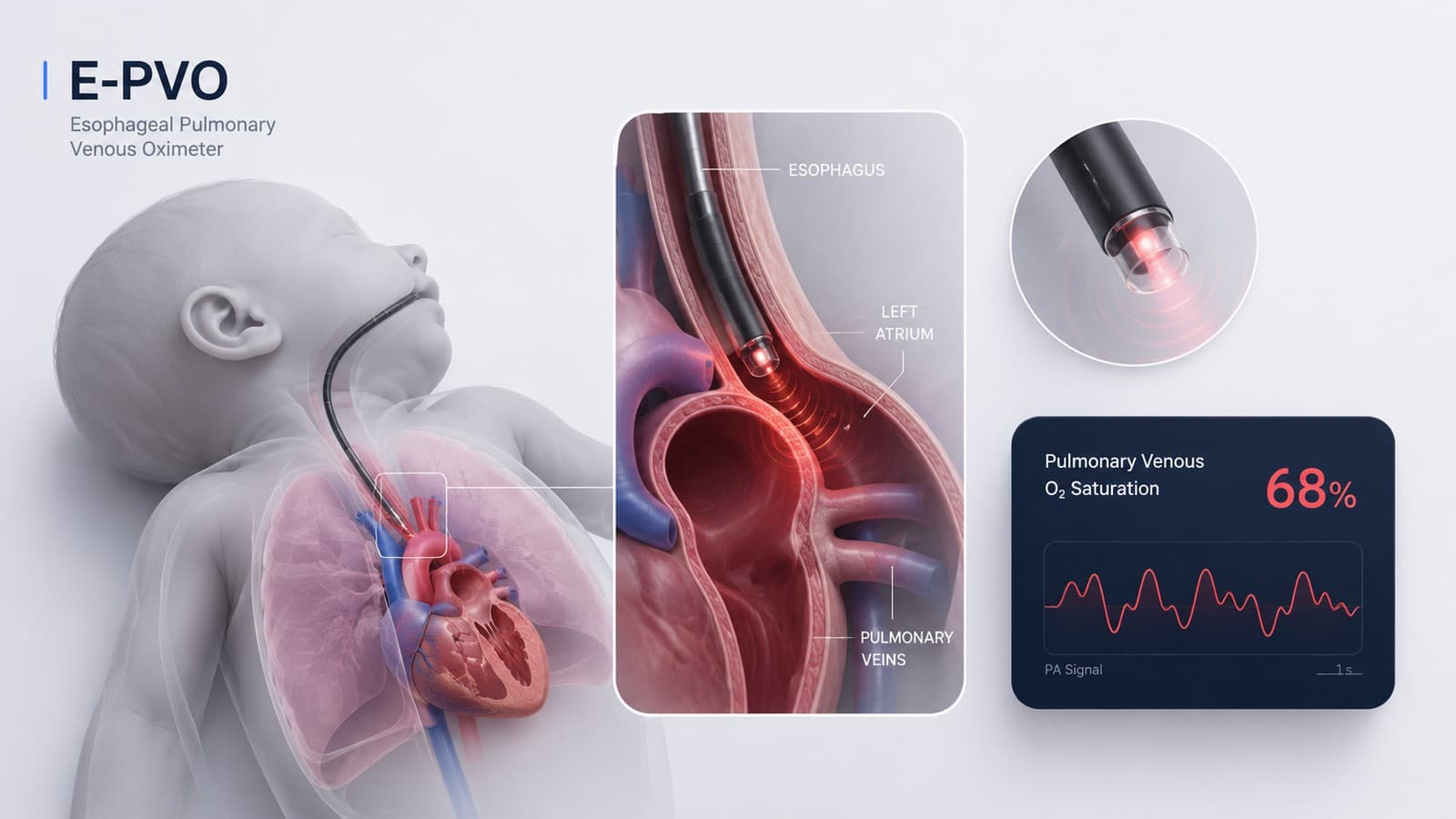 Illustration of the E-PVO probe positioned transesophageally near the left atrium and pulmonary veins, with a sample oxygen-saturation readout
